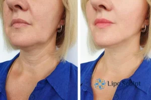 Double chin before and after Hi-Fu treatment 4 Book your double chin treatment South Ockendon today! We are here to help!
