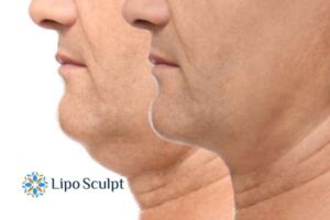 Double chin before and after Hi-Fu treatment 2 Double chin treatment South Ockendon from Lipo Sculpt - feel more confident today!