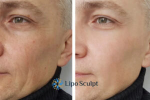 How to Fight Aging Symptoms 3 Fight Aging Symptoms South Ockendon With HIFU and Morpheus8 Today!
