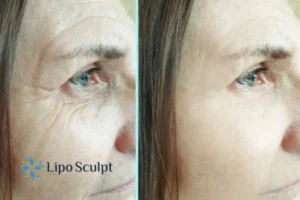 How to Fight Aging Symptoms 2 Do you want to Fight Aging Symptoms South Ockendon? Contact Lipo Sculpt today!