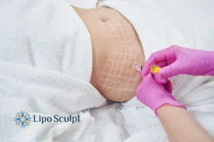 Are The Results From Aqualyx Permanent? 1 Do you want to know how long Aqualyx South Ockendon results last?