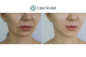 Explaining Total Skin Tightening Treatment And What It Can Do For You 2 Do you want to boost your self confidence? Give Morpheus8 South Ockendon a try today!