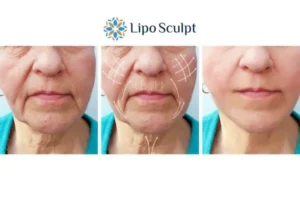 Explaining Total Skin Tightening Treatment And What It Can Do For You 3 Boost your confidence with Morpheus8 South Ockendon call our team today!