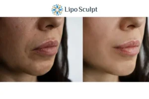 Explaining Total Skin Tightening Treatment And What It Can Do For You 4 Morpheus8 South Ockendon the best results - call our team today!