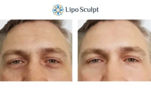 Explaining Total Skin Tightening Treatment And What It Can Do For You 6 Morpheus8 South Ockendon book in today to find out more!