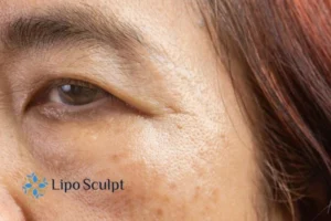 Cryopen: The Revolutionary Treatment for Age Spots Unveiled 2 Are age spots South Ockendon giving you low self esteem? Contact us today!