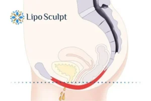 Pelvic Floor Chair Therapy 1 Pelvic Floor Chair Therapy South Ockendon to treat incontinence.