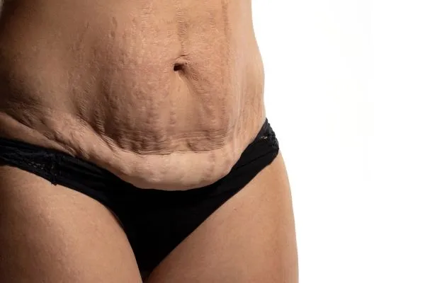 Lost the Weight but Not the Loose Skin? 1 image of womans stomach after weight loss showing loose skin South Ockendon